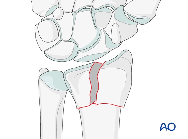 Перелом лучевой кости