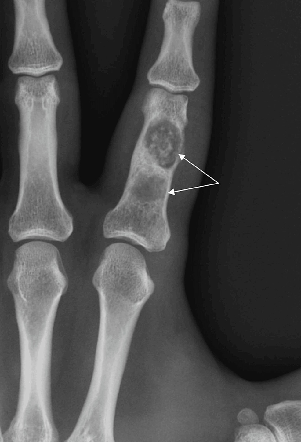 Опухоли кости (L-хондрома)