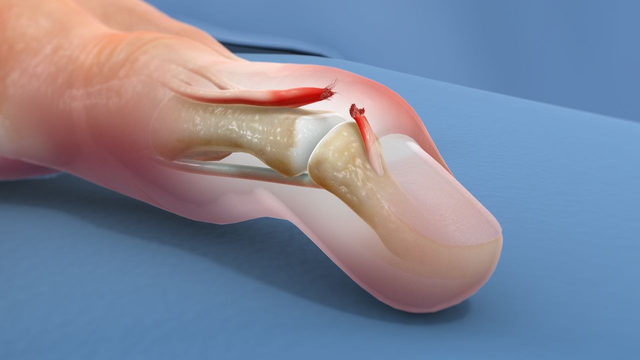 Растяжения и разрывы связок пальцев