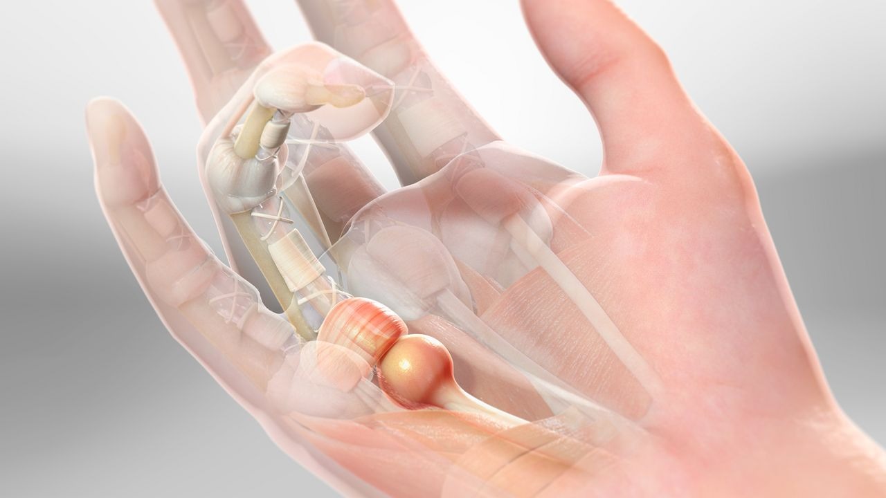 Болезнь Нотта