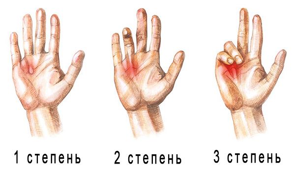 Диагностика контрактуры Дюпюитрена