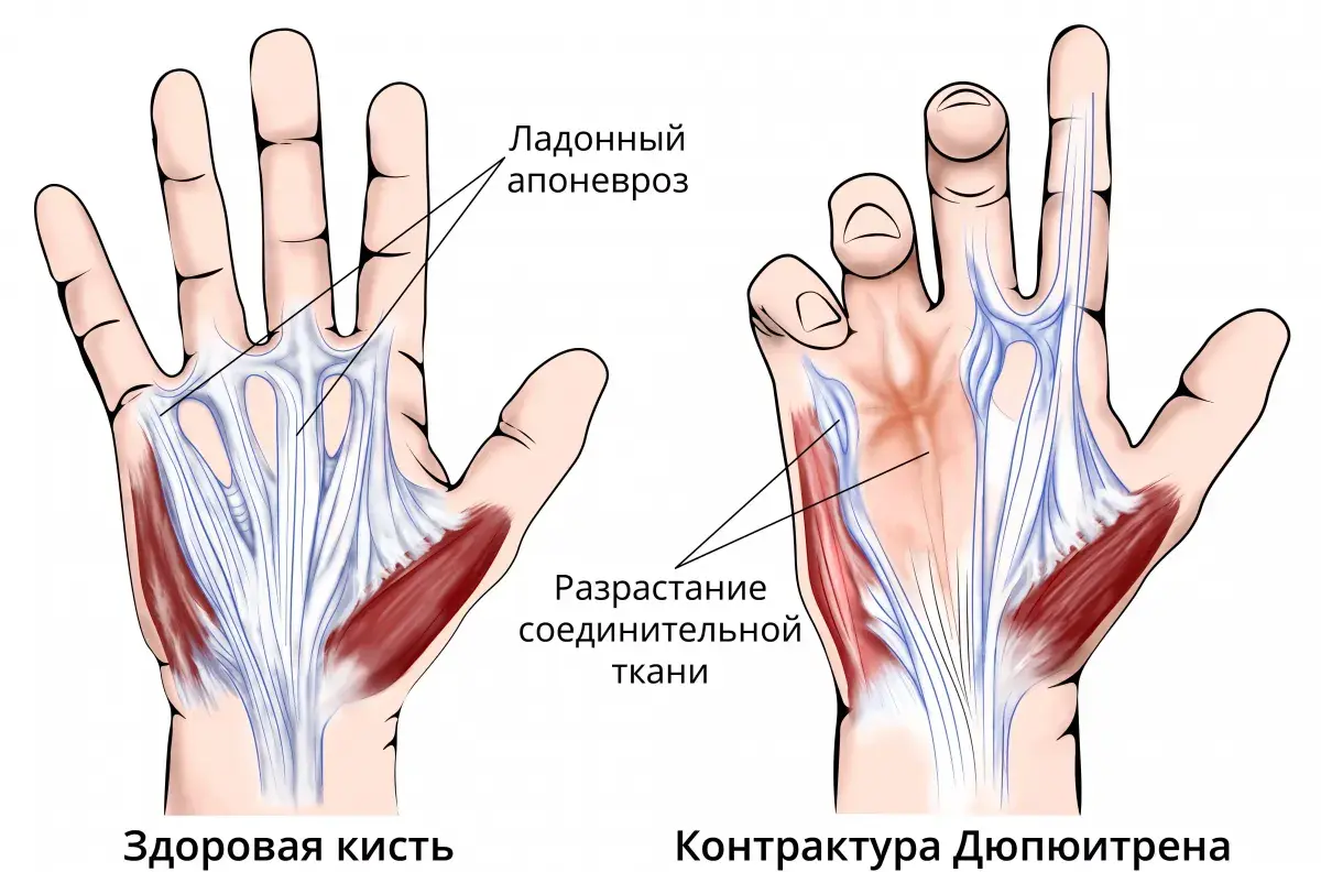 Дооперационная оценка контрактуры