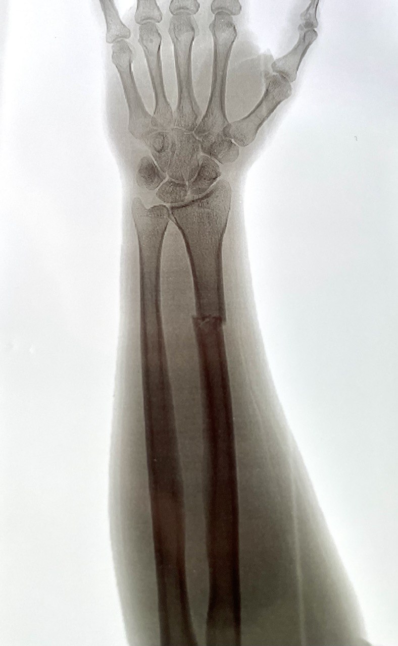 Перелом диафиза лучевой кости: снимок 1