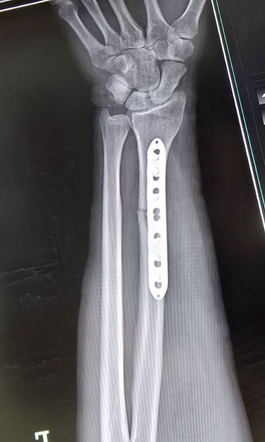 Перелом диафиза лучевой кости: снимок 2