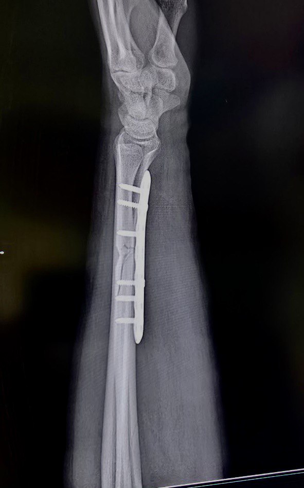 Перелом диафиза лучевой кости: снимок 3