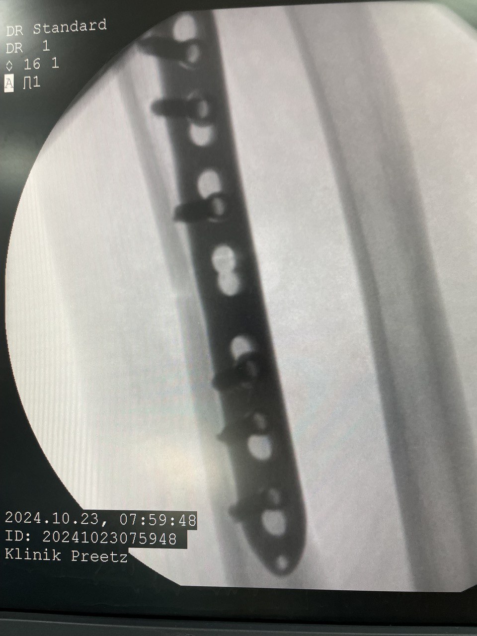 Перелом диафиза лучевой кости: снимок 4