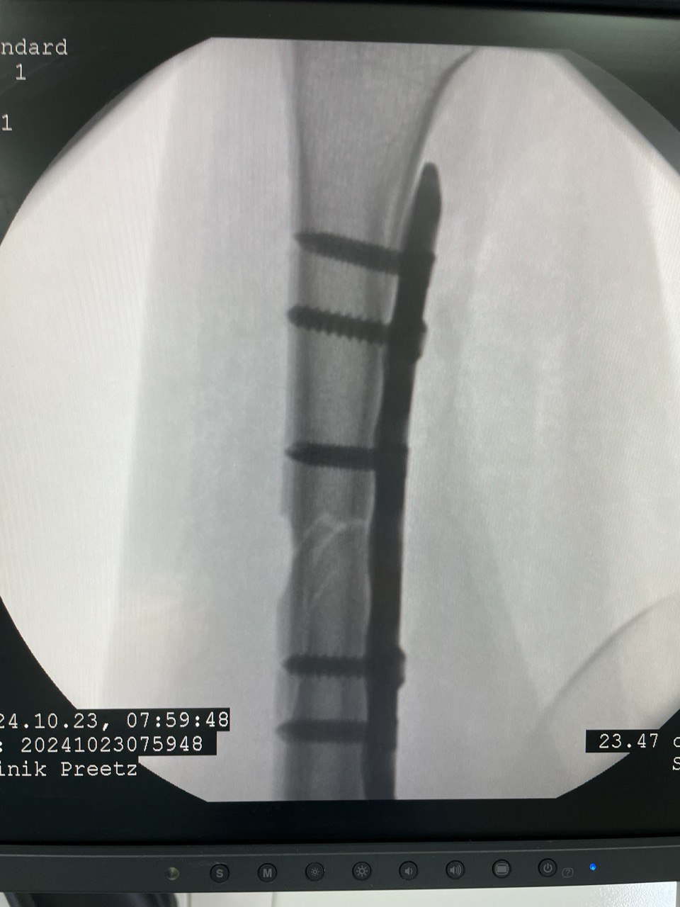 Перелом диафиза лучевой кости: снимок 5