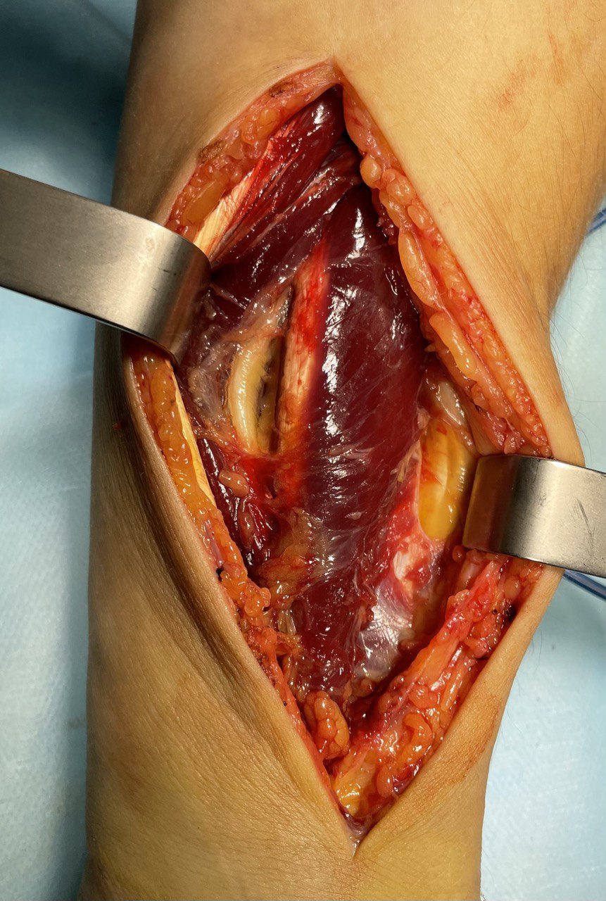 Перелом диафиза лучевой кости: снимок 6