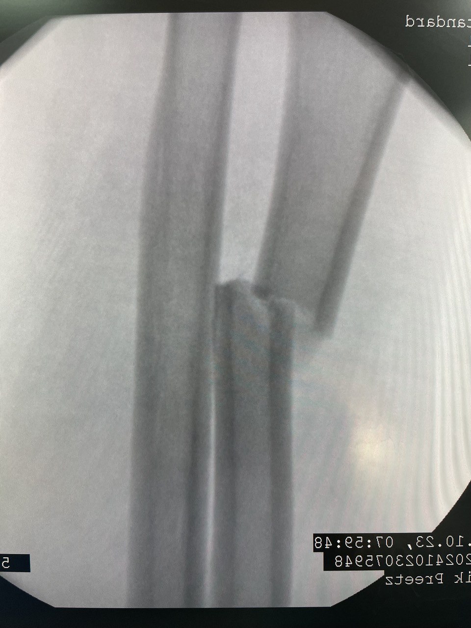 Перелом диафиза лучевой кости: снимок 7