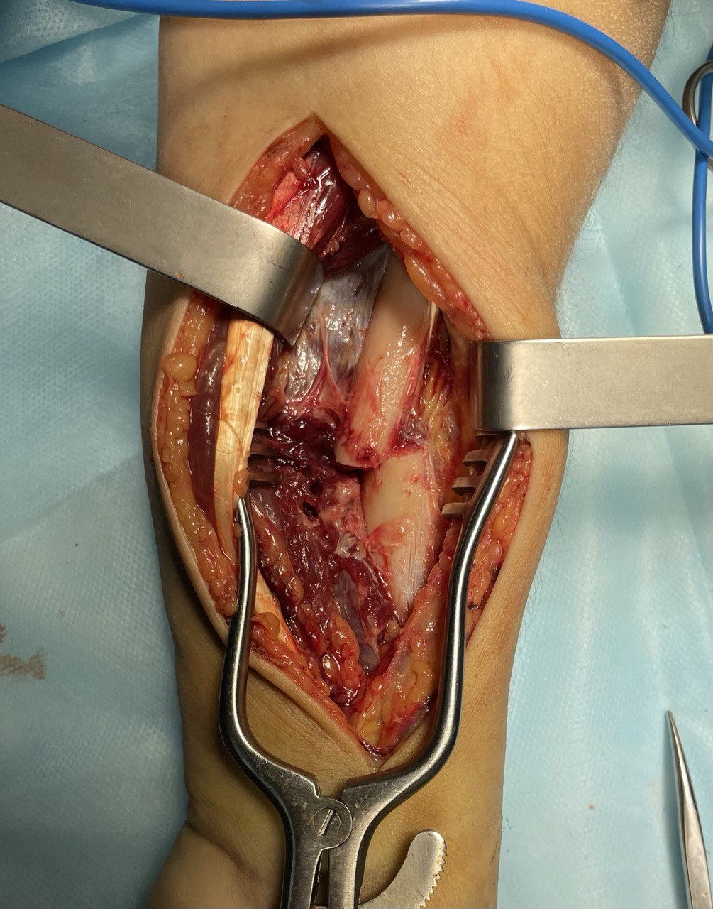 Перелом диафиза лучевой кости: снимок 8