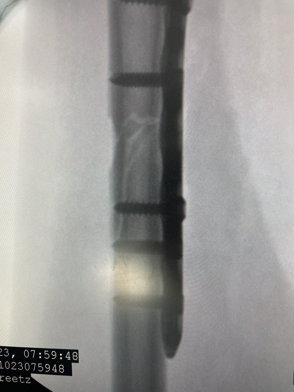 Перелом диафиза лучевой кости: снимок 9