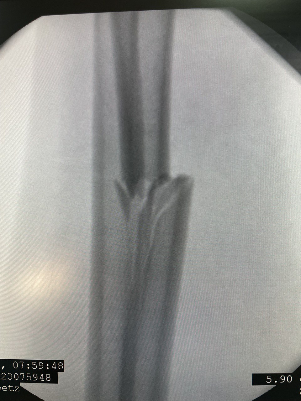 Перелом диафиза лучевой кости: снимок 10