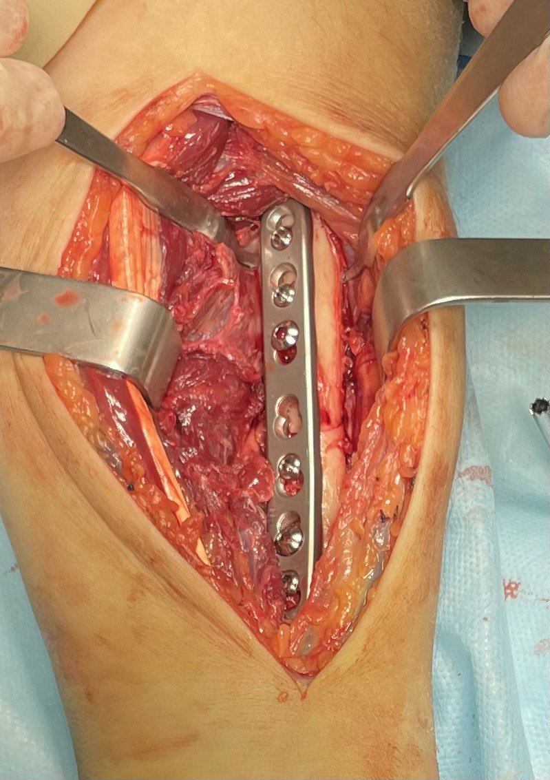 Перелом диафиза лучевой кости: снимок 11