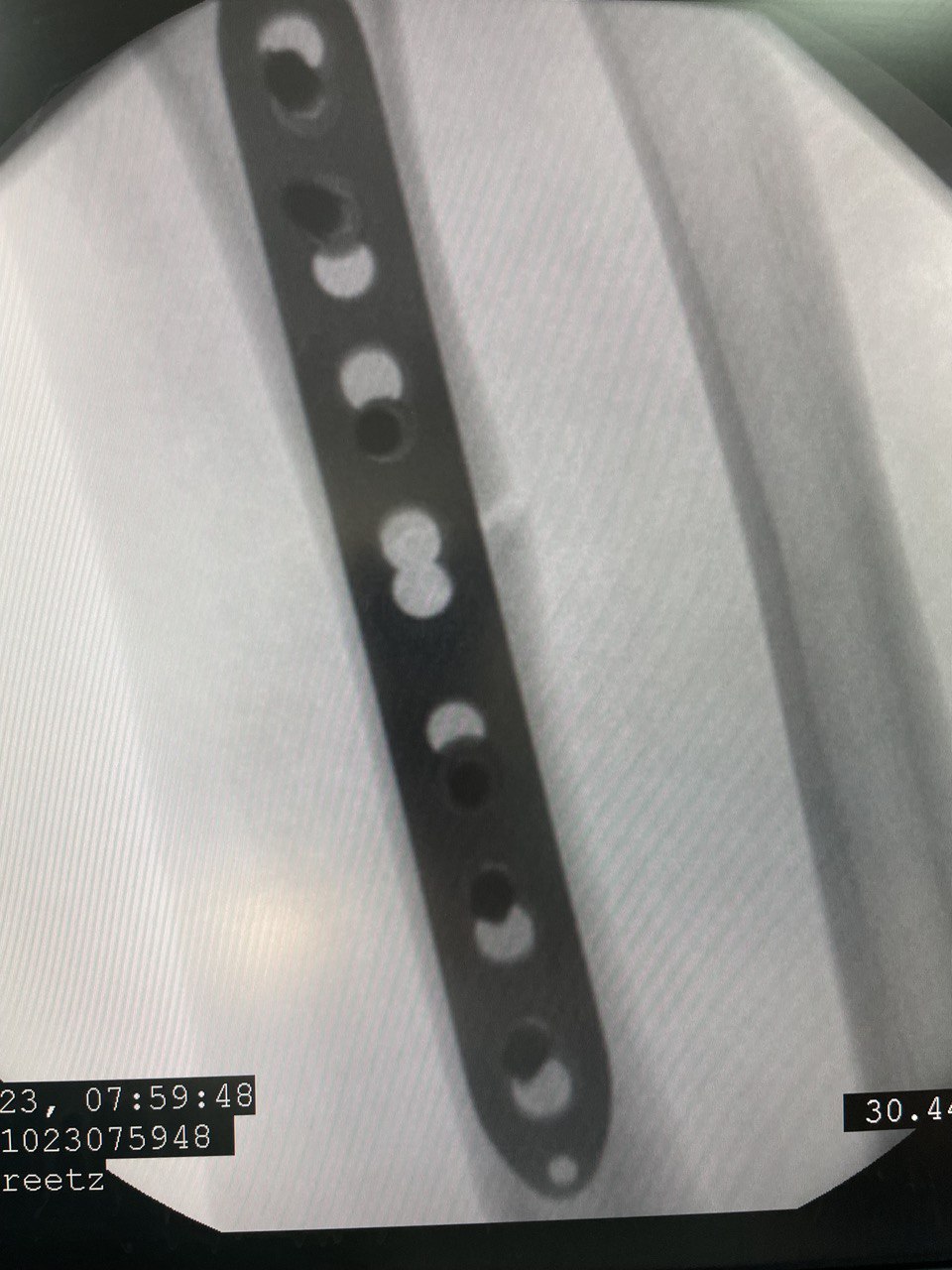 Перелом диафиза лучевой кости: снимок 12