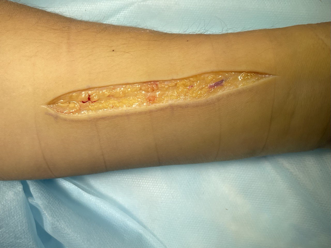 Перелом диафиза лучевой кости: снимок 13