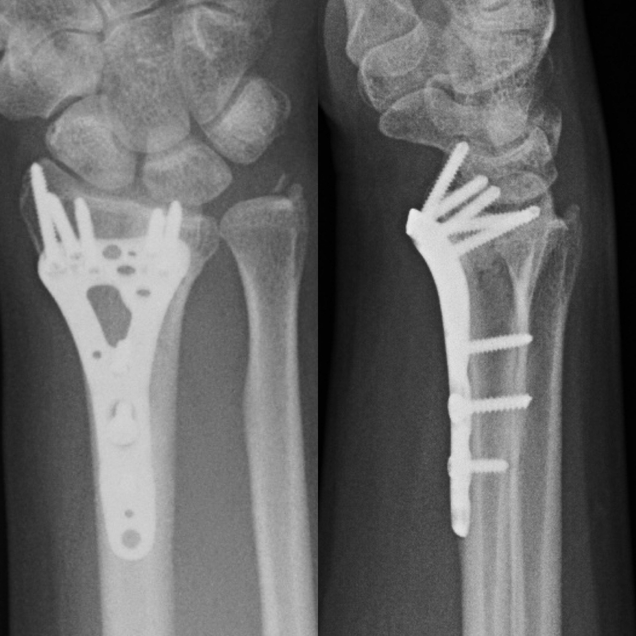 Операция: этап остеосинтеза, снимок 1