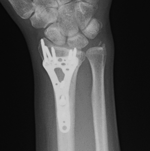 Операция: этап остеосинтеза, снимок 3