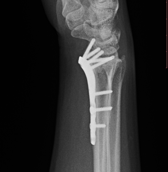 Операция: этап остеосинтеза, снимок 4