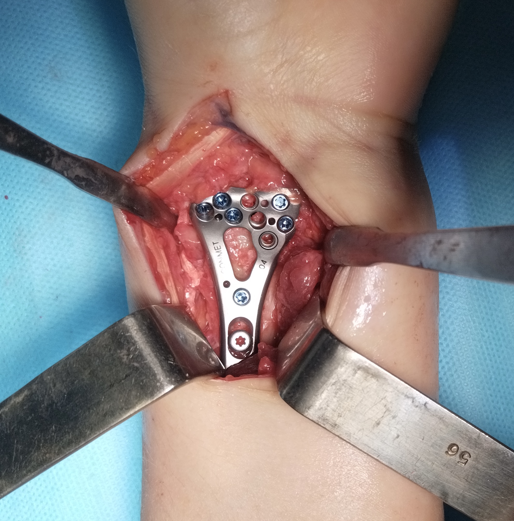 Операция: этап остеосинтеза, снимок 5