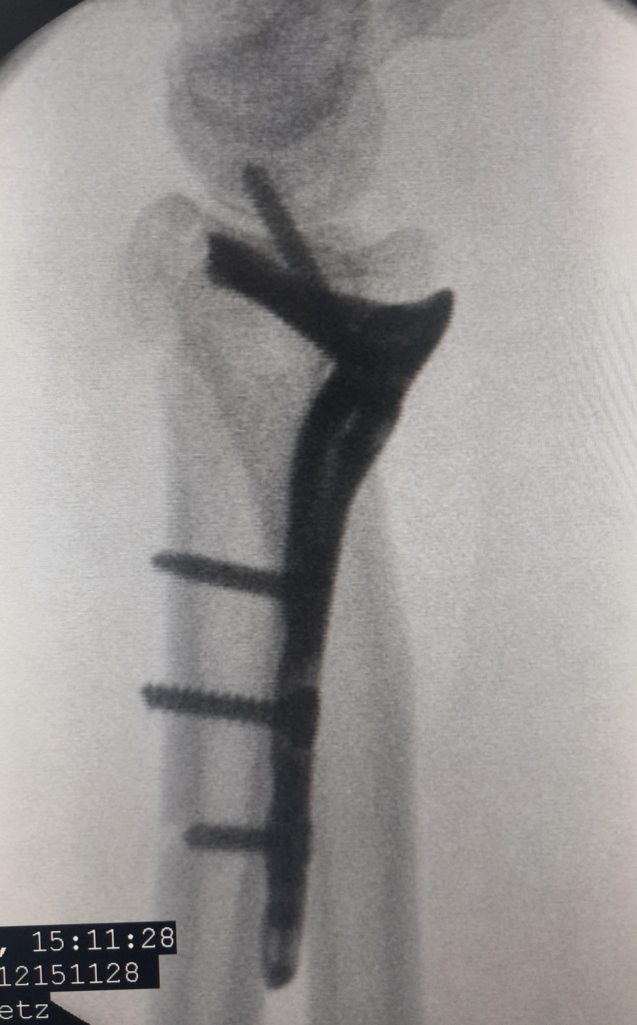 Операция: этап остеосинтеза, снимок 6