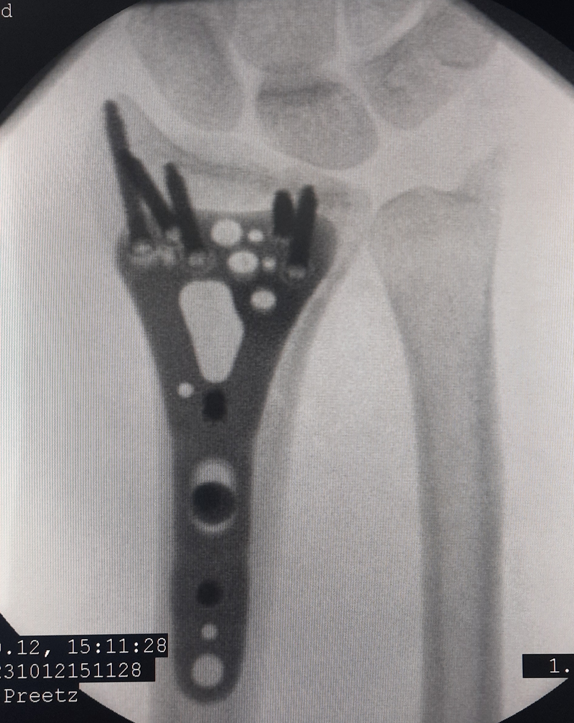 Операция: этап остеосинтеза, снимок 8