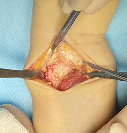 Операция: этап остеосинтеза, снимок 9